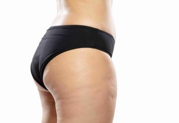 Cellulite: Cos'è e come combatterla